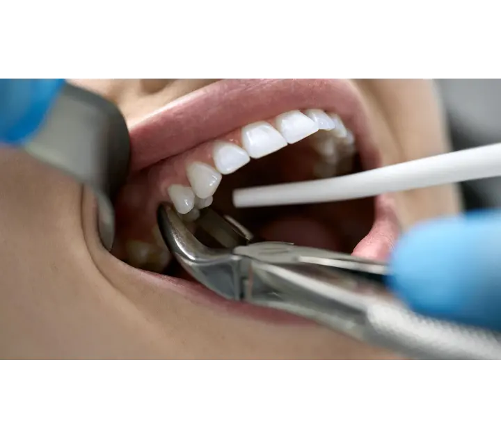 Екстракция на зъб